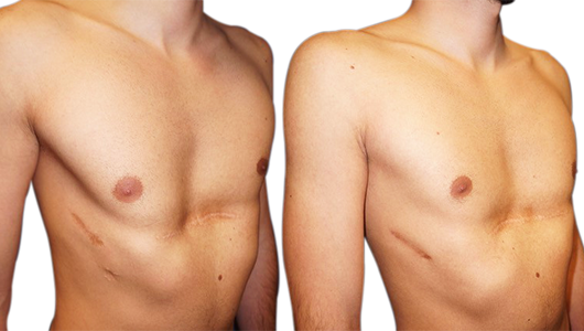 Before/after picture of a Ravitch and Nuss redo on a Pectus Excavatum