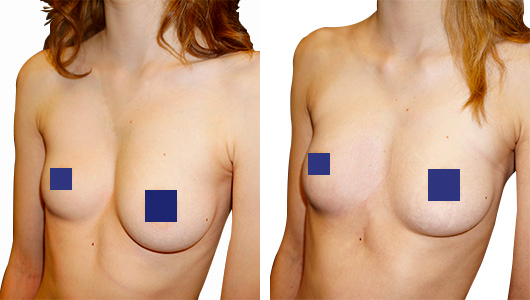 Before and after picture of a corrected Poland syndrom on a breast asymmetry