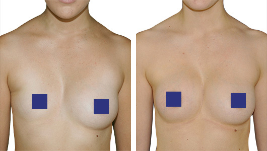 Before and after picture of a corrected Pectus Excavatum on a breast asymmetry