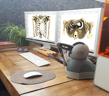 3D CAD Design of 3D custom-made implants on computer